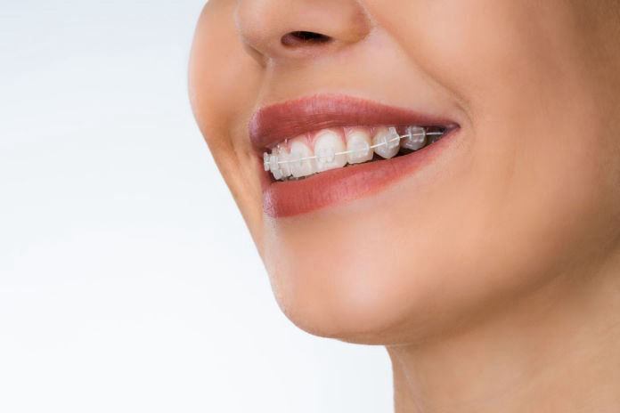 Child Tooth Colored Braces in Albuquerque NM | Success Smiles Orthodontics