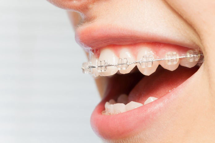 Tooth Colored Braces in Albuquerque NM | Success Smiles Orthodontics