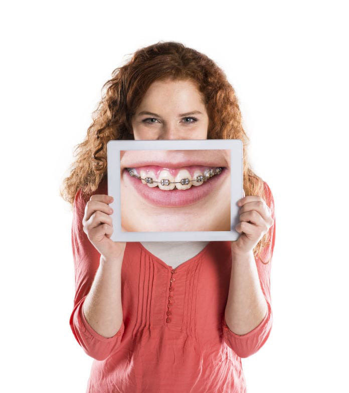Traditional Braces Vertical