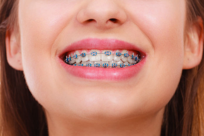 Braces in Albuquerque