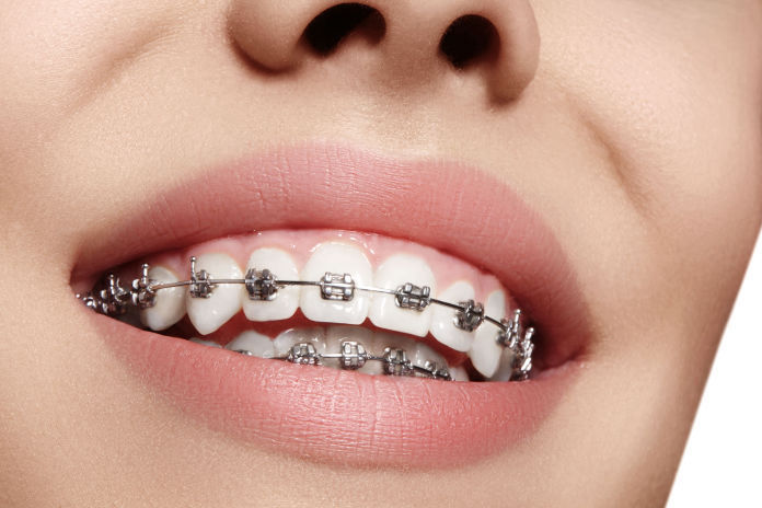 Traditional Braces in Albuquerque